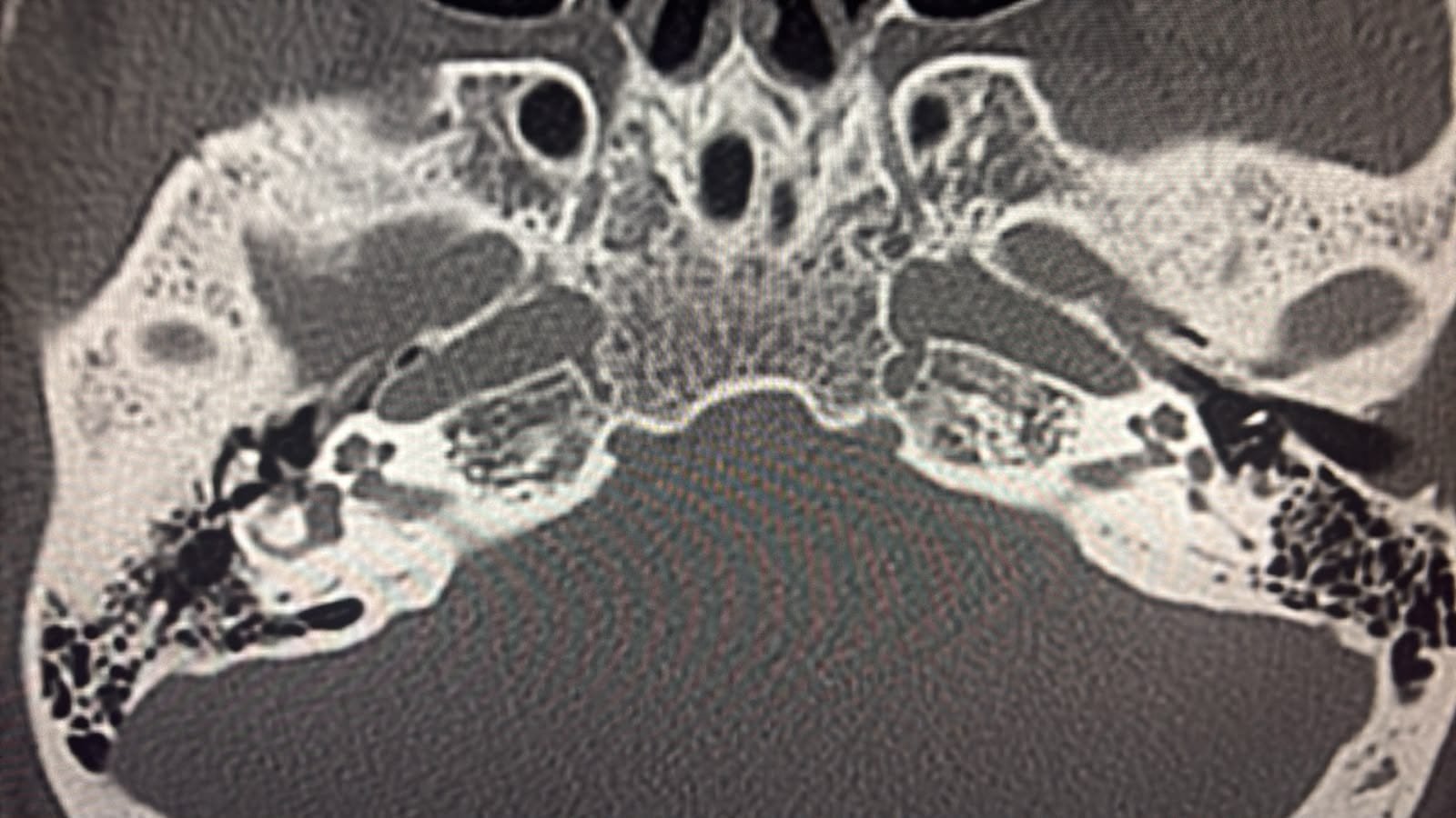 pulsatile tinnitus