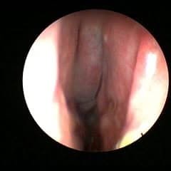 469253731_18470562457046684_6708446756964511976_n septoplasty
