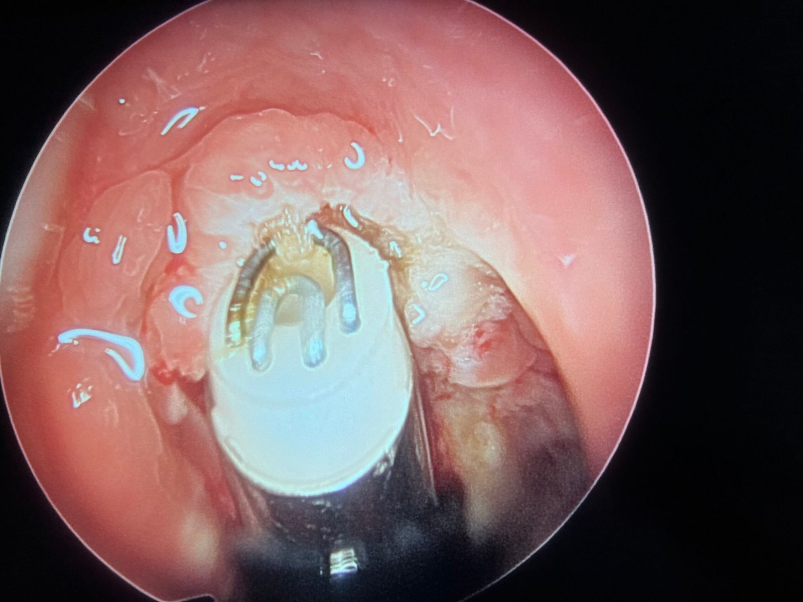 coblator adenoidectomy Endoscopic Coblator Adenoidectomy