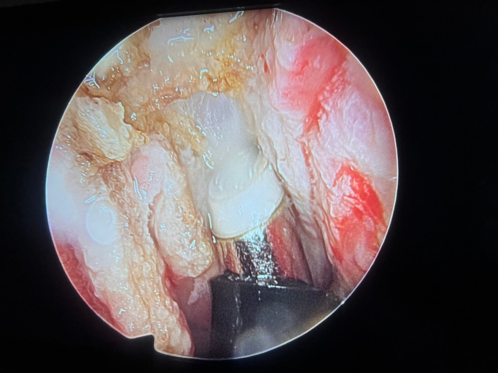 endoscopic adenoidectomy