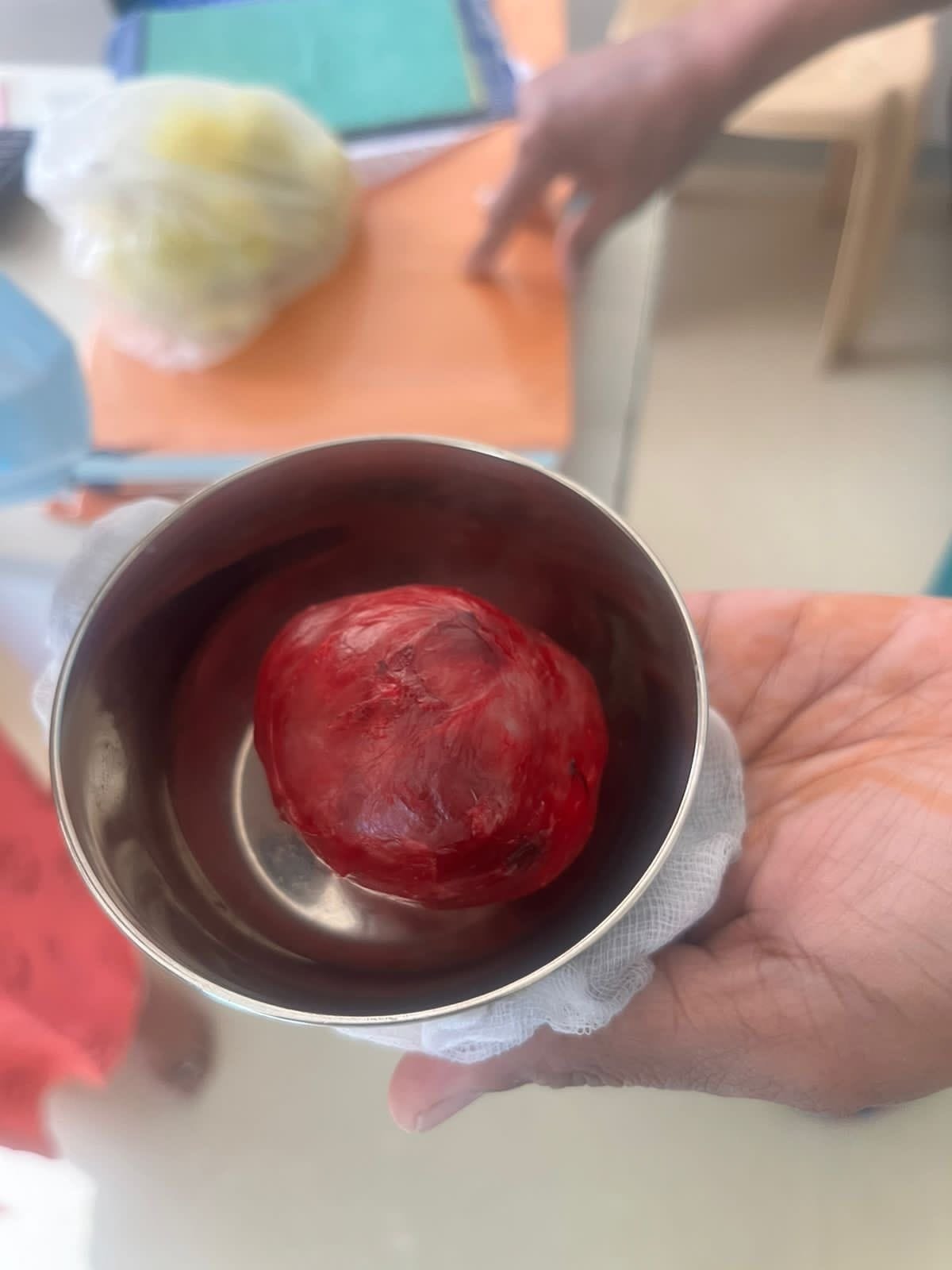 thyroidectomy, testimonial