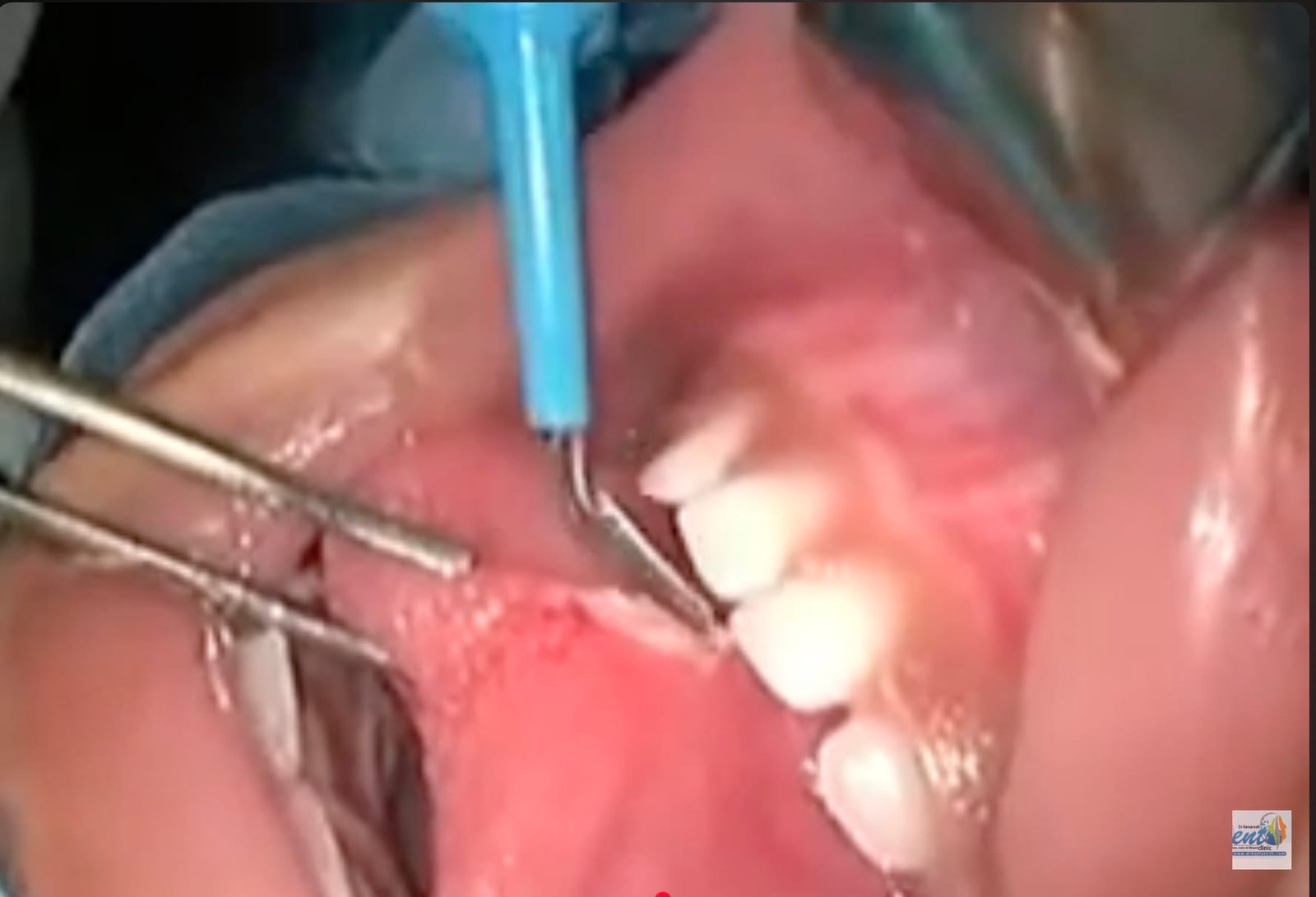 tongue tie surgery tongue tie surgery